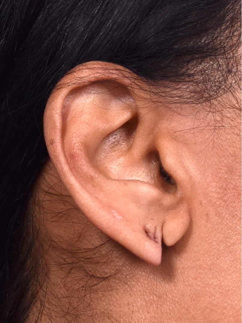 Torn earlobe piercing stretched Atlanta repair surgery ear best near me