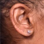 Torn earlobe piercing stretched Atlanta repair surgery ear best near me