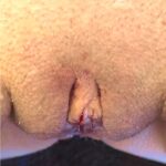 Aviva Atlanta labiaplasty near me best expert female surgeon clitoral hood reduction results