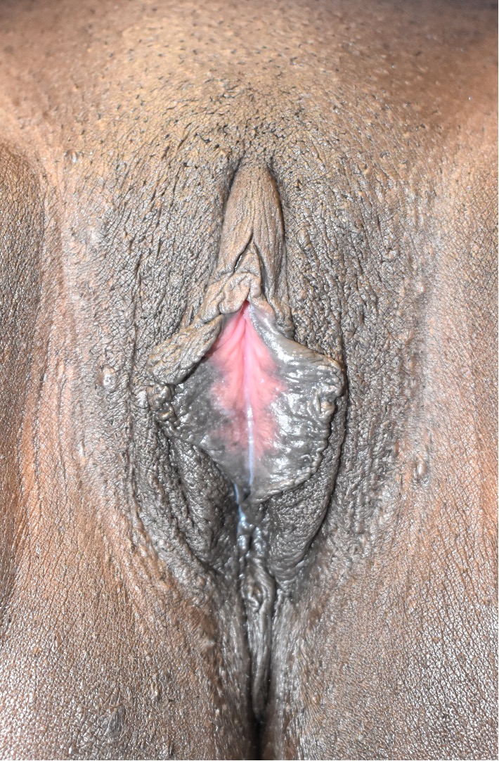 Labiaplasty near me best before after expert plastic surgery Atlanta woman surgeon clitoral hood reduction