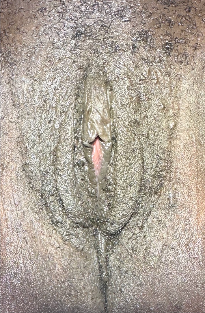 Labiaplasty near me best before after expert plastic surgery Atlanta woman surgeon clitoral hood reduction