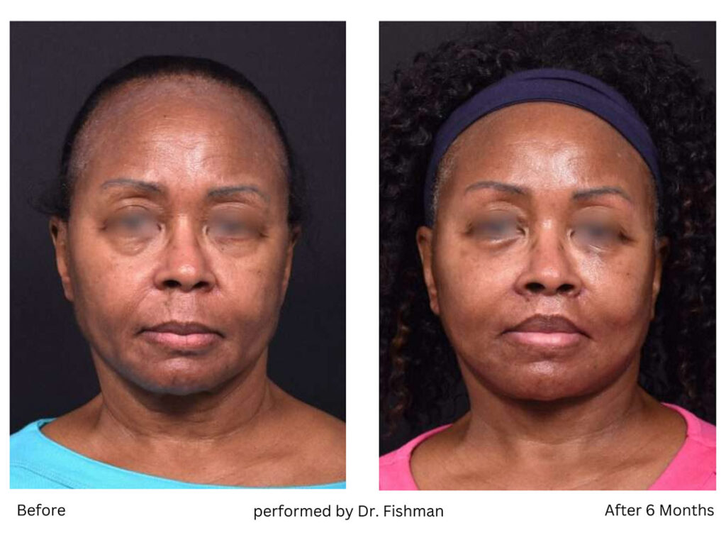 Lip Lift Before and After