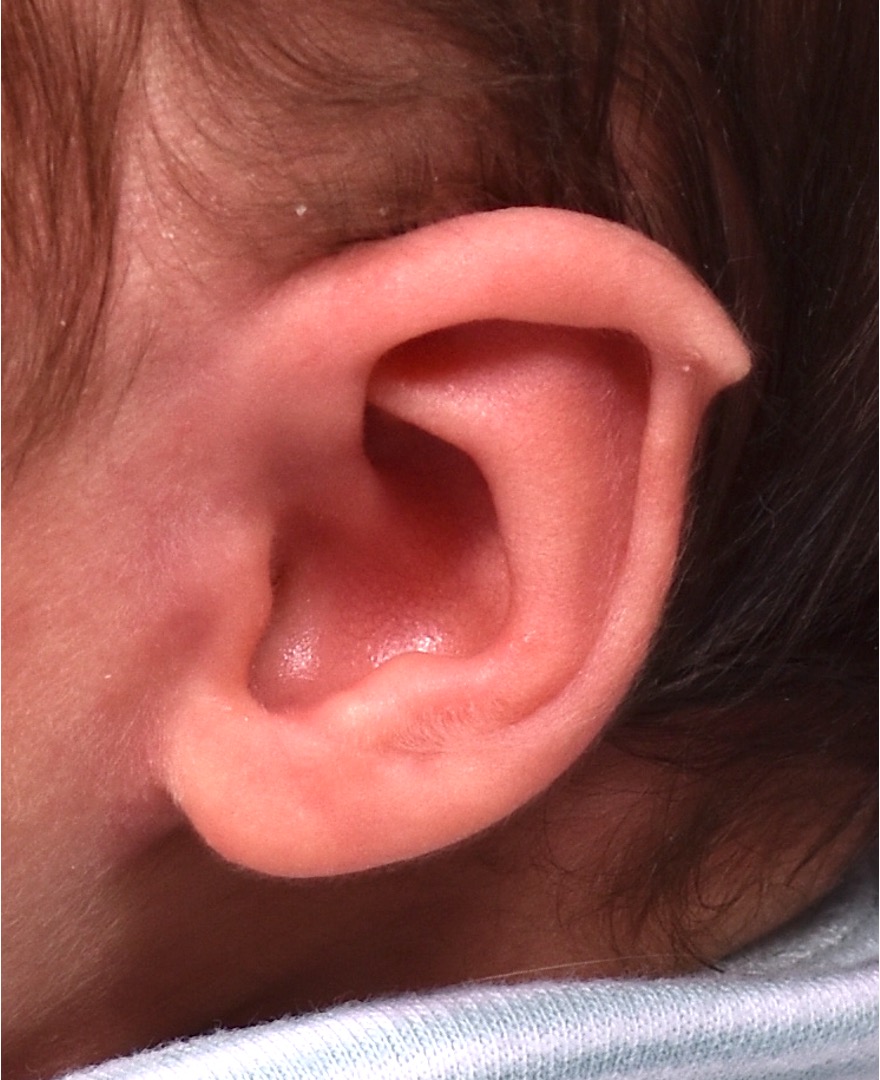 Newborn baby ear treatment Earwell Earbuddies surgery otoplasty best results expert