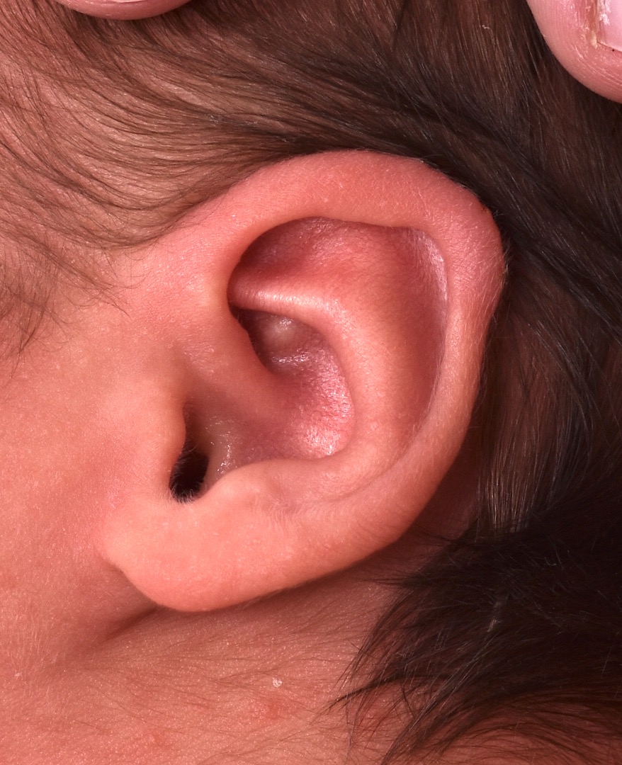 Newborn baby ear treatment Earwell Earbuddies surgery otoplasty best results expert