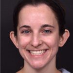 Otoplasty cost near me best expert female plastic surgeon results before after Atlanta ear surgery