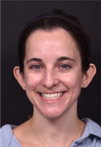 Otoplasty cost near me best expert female plastic surgeon results before after Atlanta ear surgery