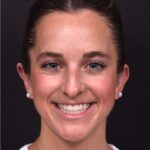 Otoplasty cost near me best expert female plastic surgeon results before after Atlanta ear surgery