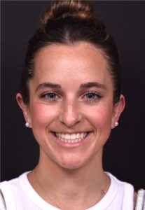 Otoplasty cost near me best expert female plastic surgeon results before after Atlanta ear surgery