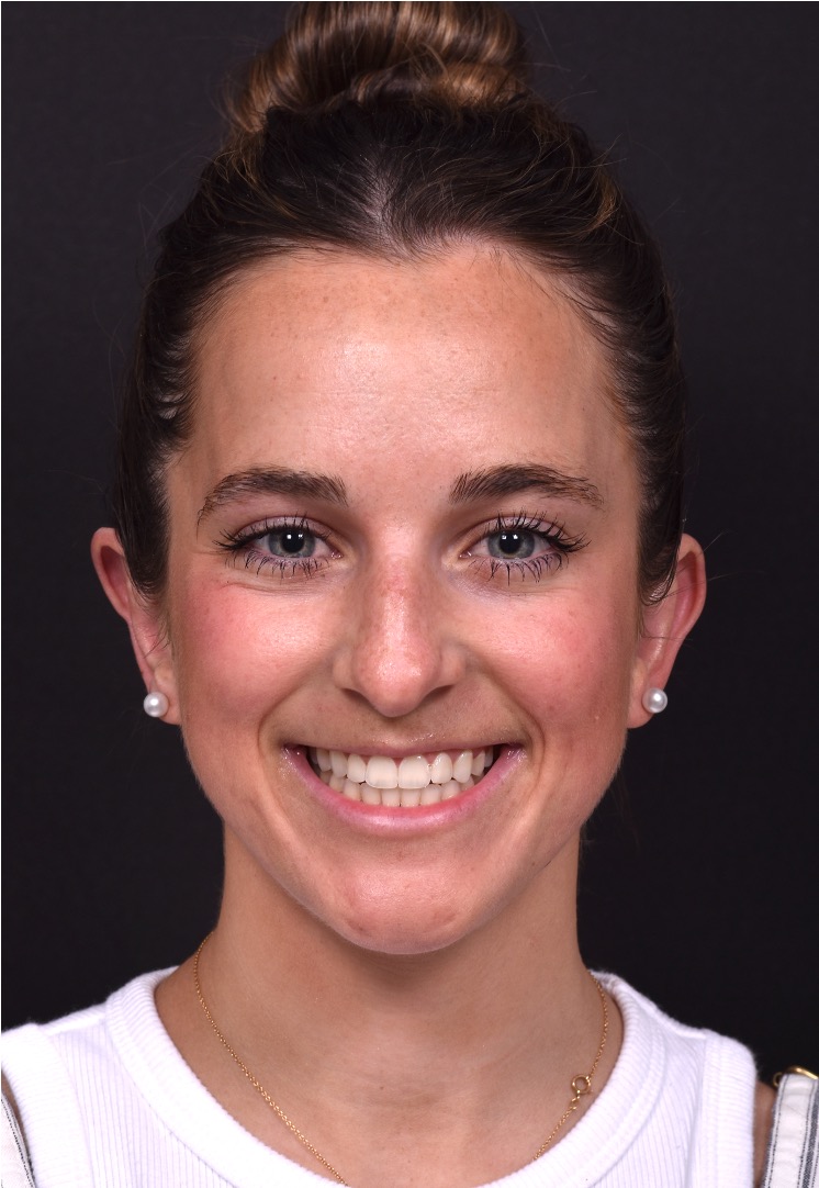 Otoplasty cost near me best expert female plastic surgeon results before after Atlanta ear surgery