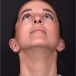 Otoplasty cost near me best expert female plastic surgeon results before after Atlanta ear surgery
