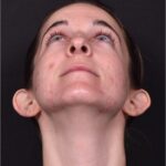Otoplasty cost near me best expert female plastic surgeon results before after Atlanta ear surgery