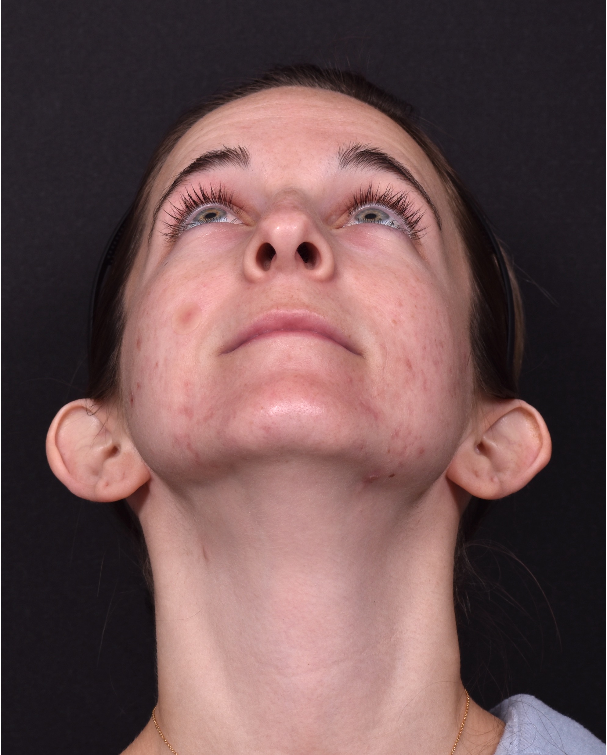 Otoplasty cost near me best expert female plastic surgeon results before after Atlanta ear surgery