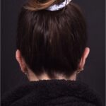 Otoplasty cost near me best expert female plastic surgeon results before after Atlanta ear surgery