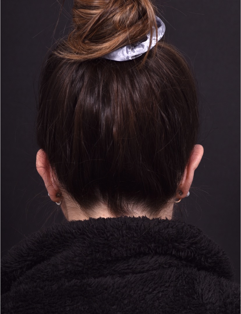 Otoplasty cost near me best expert female plastic surgeon results before after Atlanta ear surgery