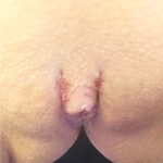 Atlanta revision labiaplasty best surgeon female intimate health wellness labia reduction surgery treatment results before after