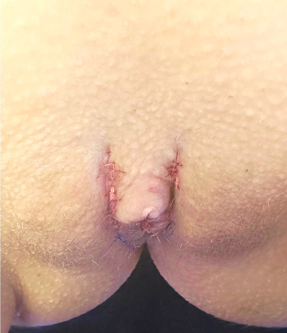 Atlanta revision labiaplasty best surgeon female intimate health wellness labia reduction surgery treatment results before after