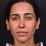 Blepharoplasty lift lift Atlanta results recovery best near me plastic surgeon female expert