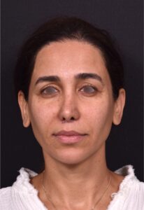 Blepharoplasty lift lift Atlanta results recovery best near me plastic surgeon female expert