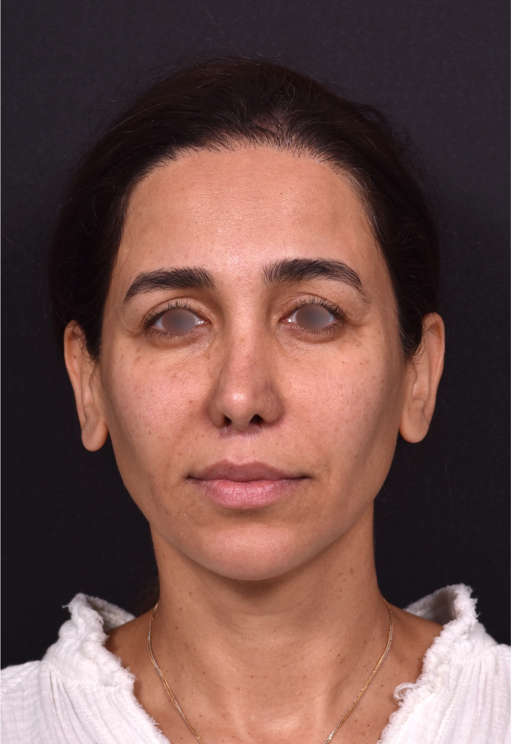 Blepharoplasty lift lift Atlanta results recovery best near me plastic surgeon female expert