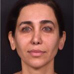 Blepharoplasty lift lift Atlanta results recovery best near me plastic surgeon female expert