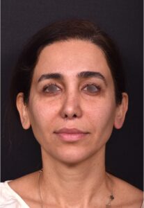Blepharoplasty lift lift Atlanta results recovery best near me plastic surgeon female expert