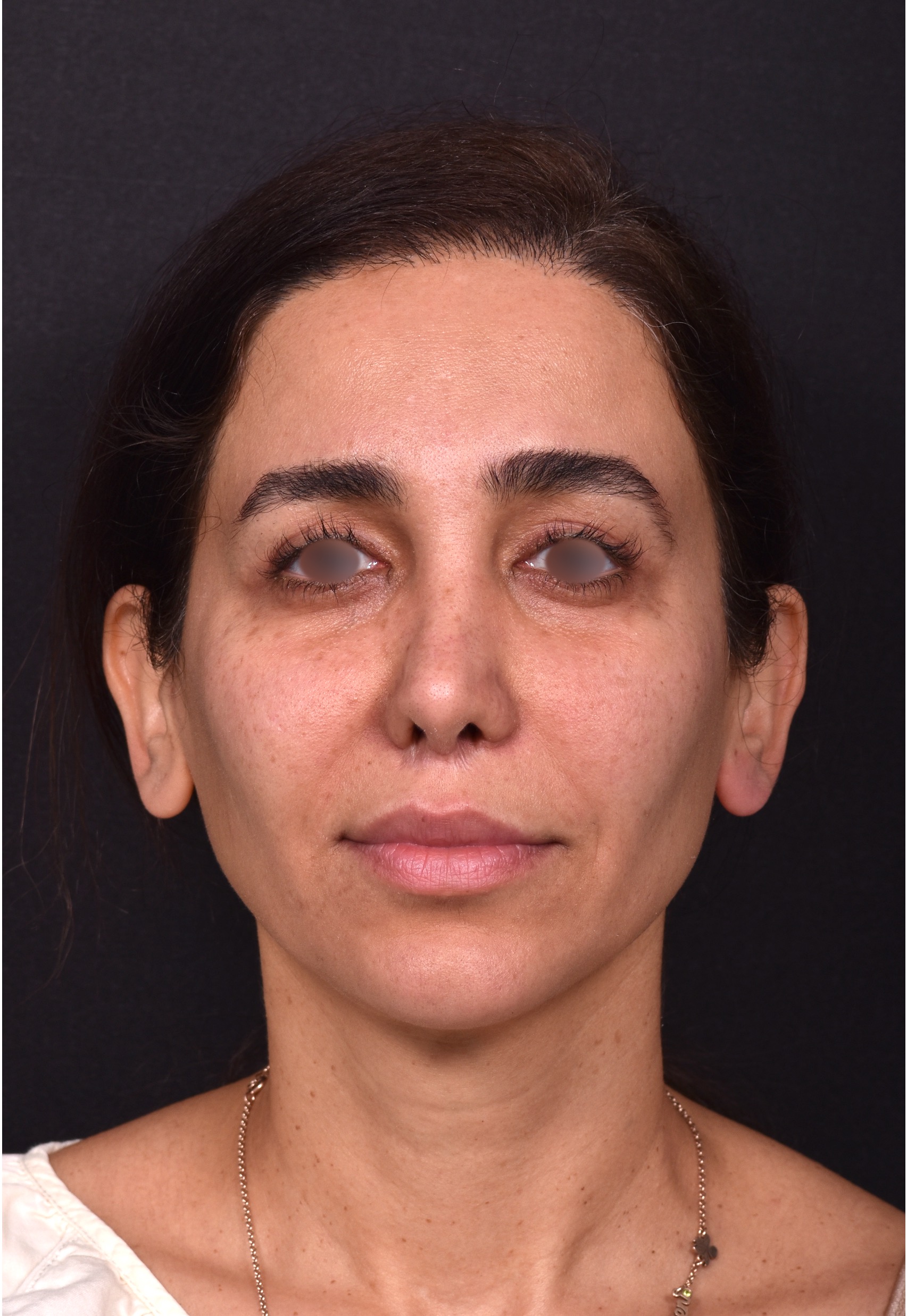 Blepharoplasty lift lift Atlanta results recovery best near me plastic surgeon female expert