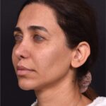 Blepharoplasty lift lift Atlanta results recovery best near me plastic surgeon female expert