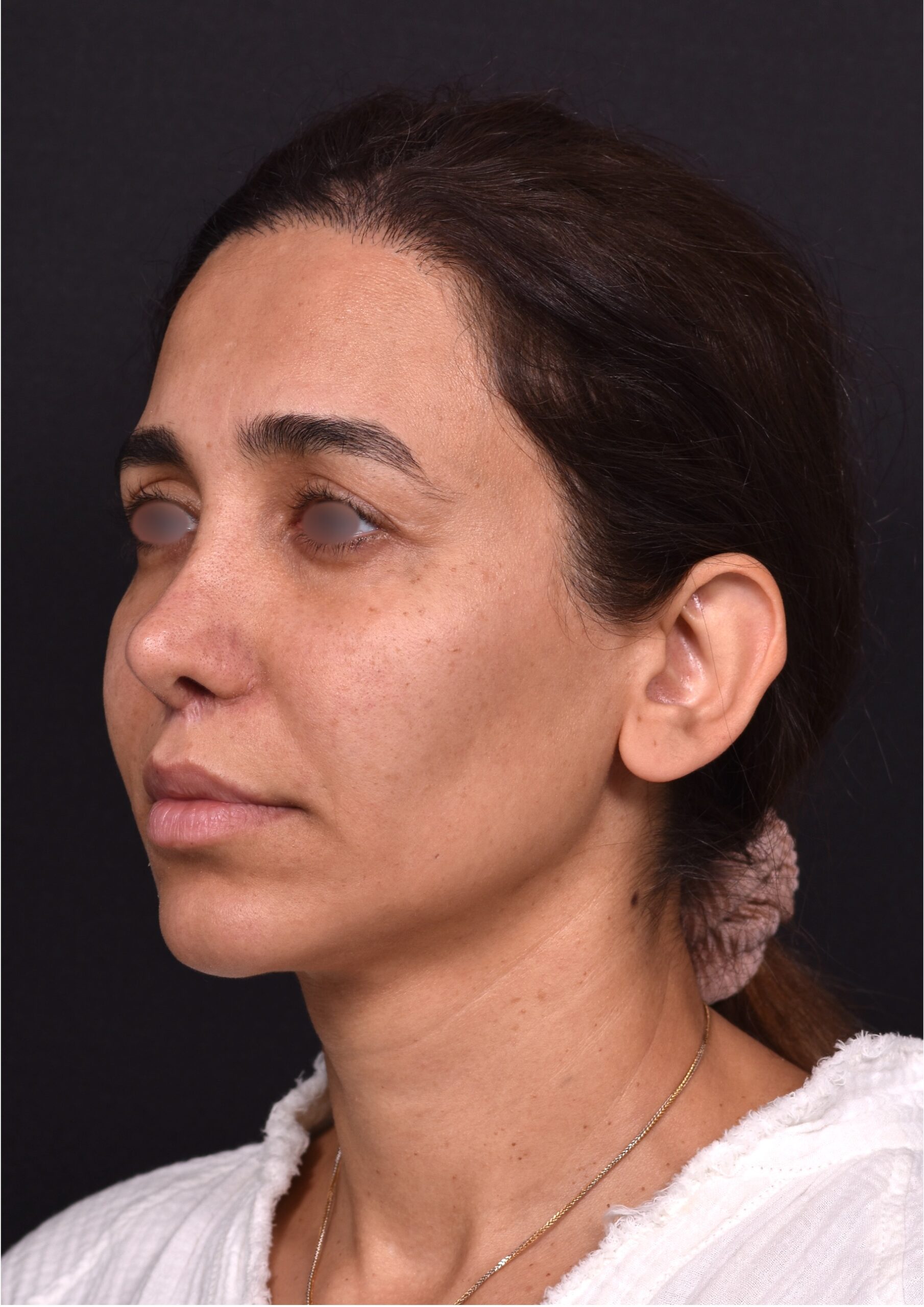 Blepharoplasty lift lift Atlanta results recovery best near me plastic surgeon female expert