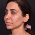 Blepharoplasty lift lift Atlanta results recovery best near me plastic surgeon female expert