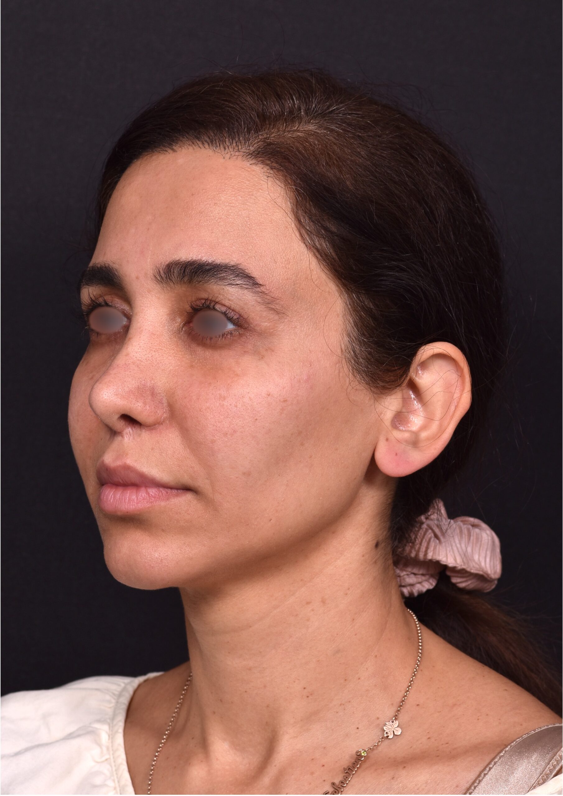 Blepharoplasty lift lift Atlanta results recovery best near me plastic surgeon female expert