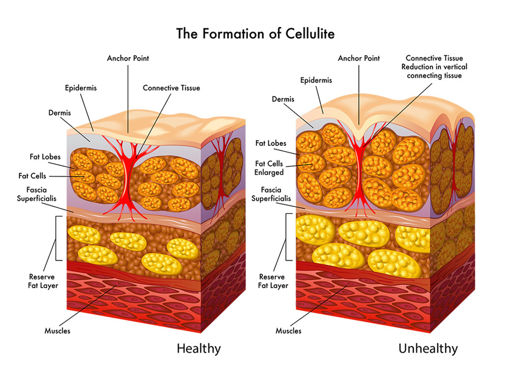 Understanding Cellulite