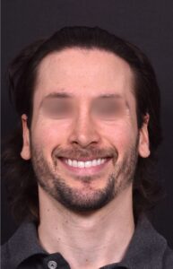 Otoplasty Atlanta near me revision ear pinning surgery earlobe best expert surgeon