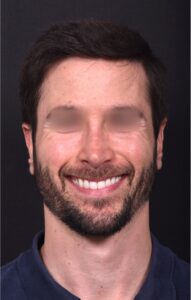 Otoplasty Atlanta near me revision ear pinning surgery earlobe best expert surgeon
