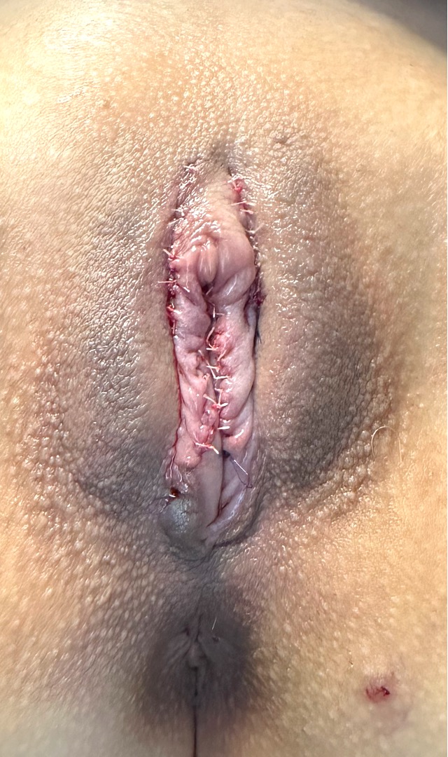 Atlanta best labiaplasty near me expert intimate wellness reduction surgery before after female