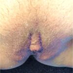 Labiaplasty Atlanta Aviva clitoral hood reduction nonsurgical best expert female plastic surgeon recovery results before after surgery