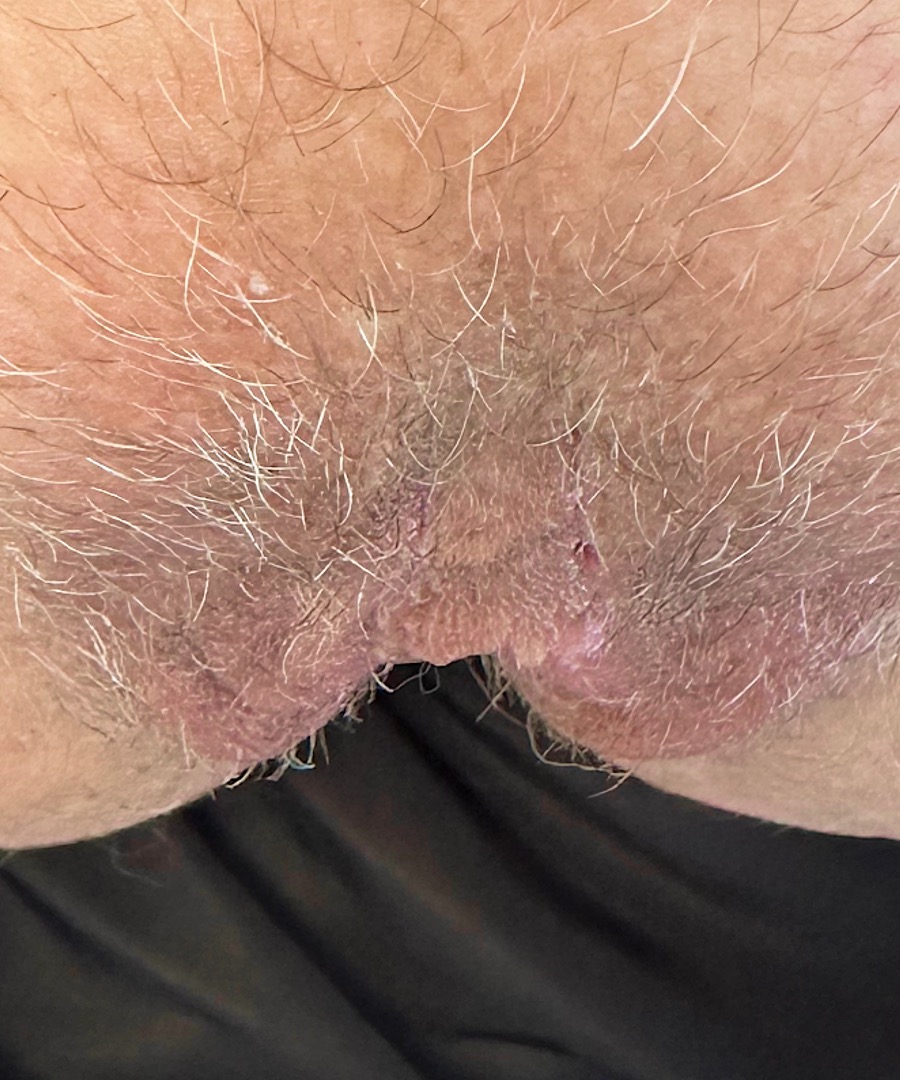 Labiaplasty Atlanta best expert results before and after female plastic surgeon intimate wellness