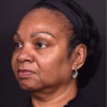 Facelift Atlanta deep plane necklift near me best expert female plastic surgeon before after results