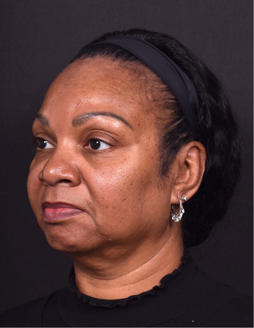 Facelift Atlanta deep plane necklift near me best expert female plastic surgeon before after results