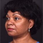 Facelift Atlanta deep plane necklift near me best expert female plastic surgeon before after results