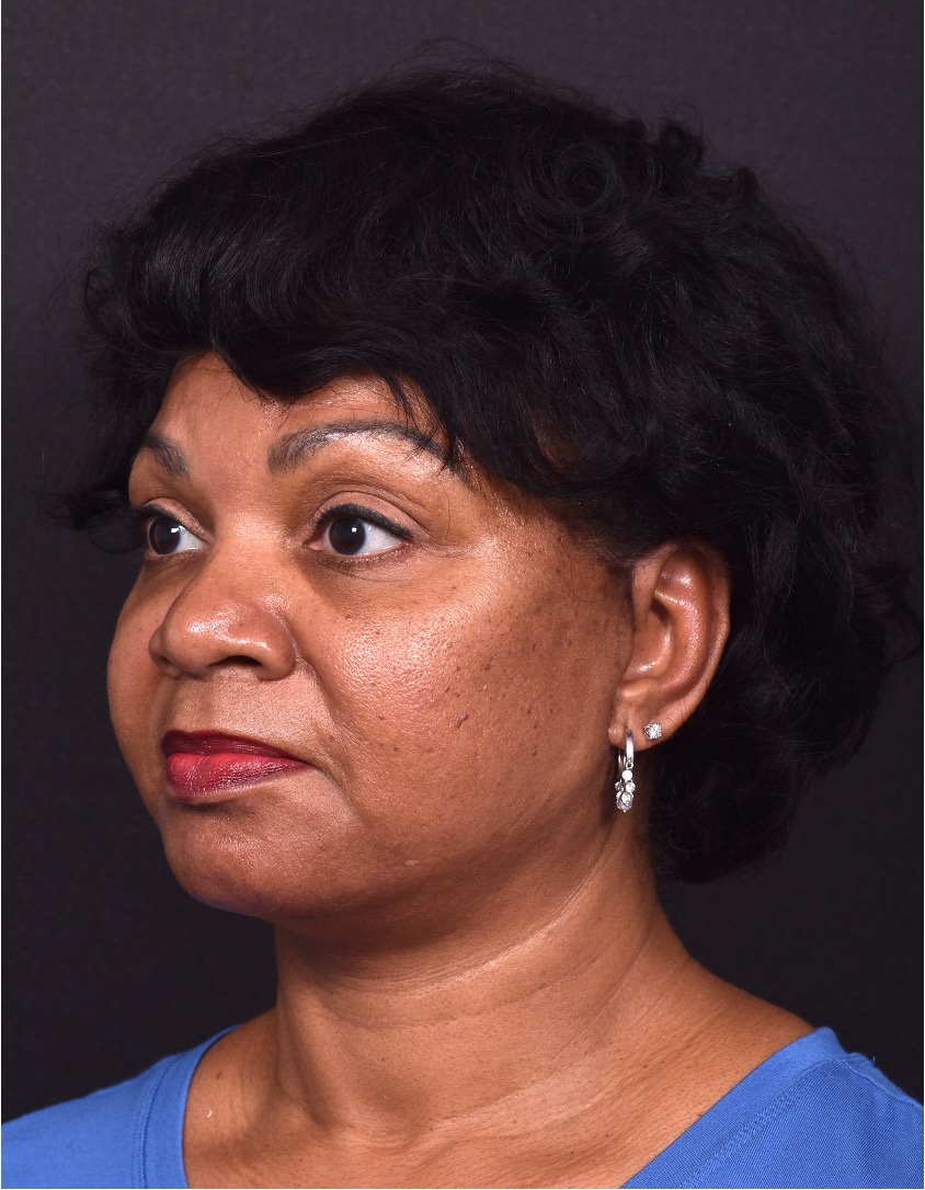 Facelift Atlanta deep plane necklift near me best expert female plastic surgeon before after results