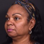 Facelift Atlanta deep plane necklift near me best expert female plastic surgeon before after results