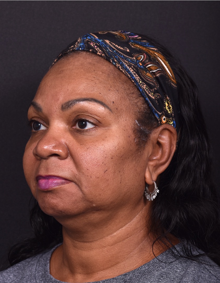 Facelift Atlanta deep plane necklift near me best expert female plastic surgeon before after results