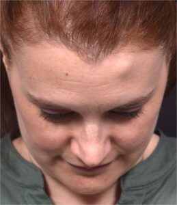 Forehead osteoma Atlanta scarless surgery treatment bump hard knot before after near me best expert plastic surgery