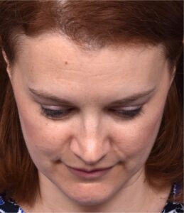 Forehead osteoma Atlanta scarless surgery treatment bump hard knot before after near me best expert plastic surgery