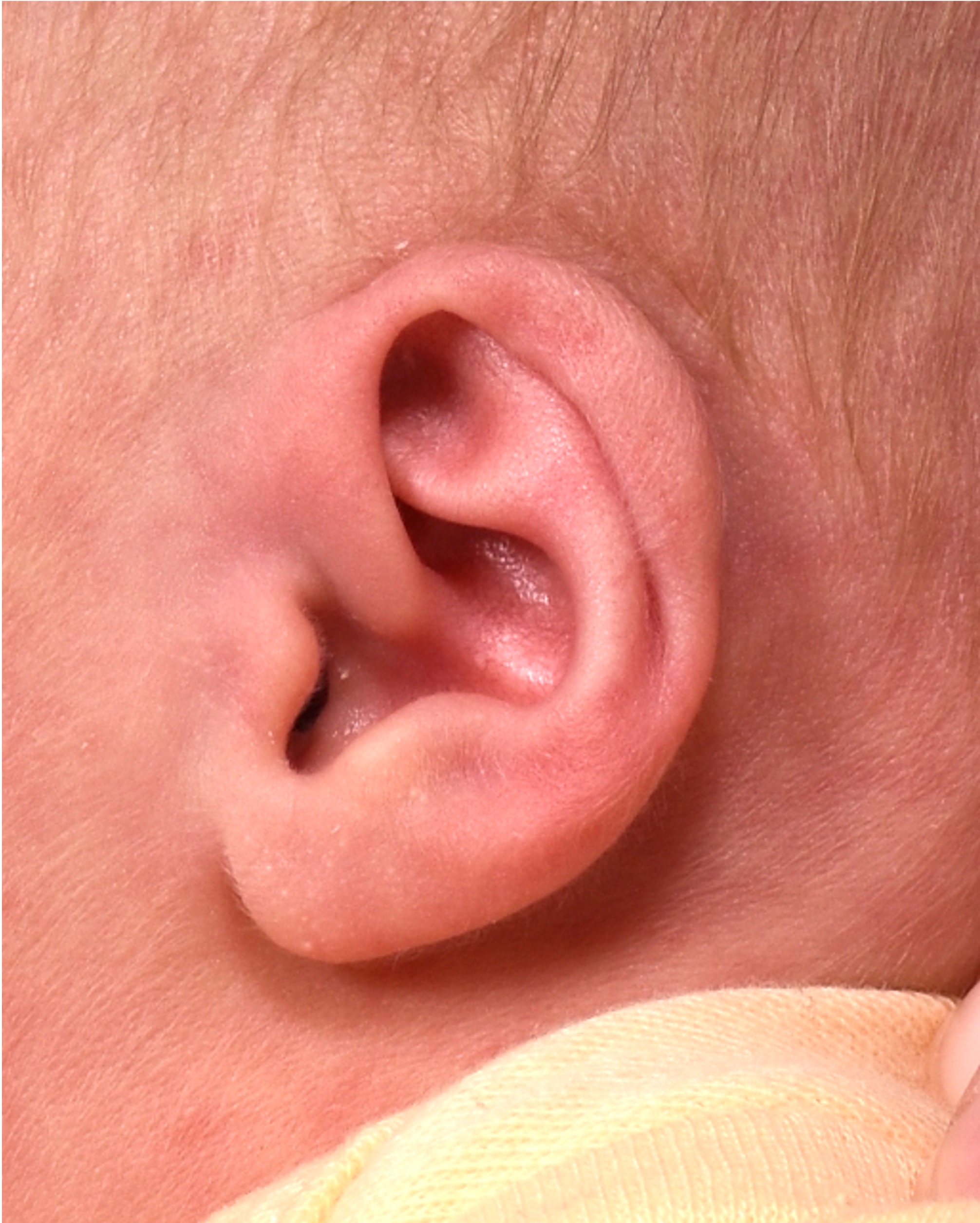 Earwell Atlanta best newborn ear correction deformity otoplasty nonsurgical before after results