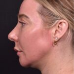 Atlanta chin implant revision natural scarless facial contouring balancing best before after female plastic surgery