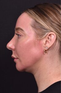 Atlanta chin implant revision natural scarless facial contouring balancing best before after female plastic surgery