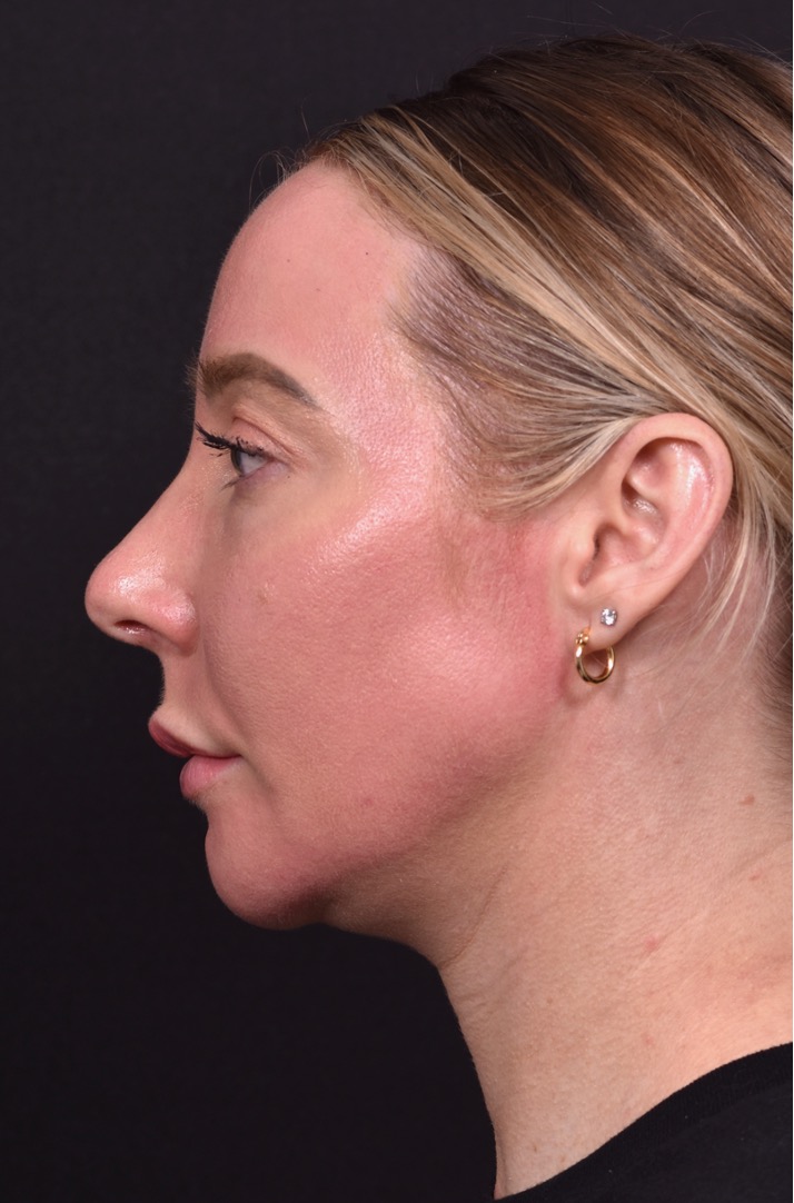 Atlanta chin implant revision natural scarless facial contouring balancing best before after female plastic surgery