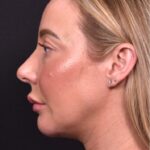 Atlanta chin implant revision natural scarless facial contouring balancing best before after female plastic surgery