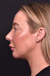 Atlanta chin implant revision natural scarless facial contouring balancing best before after female plastic surgery